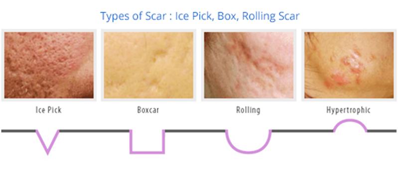 Les différents types de cicatrices d'acné
