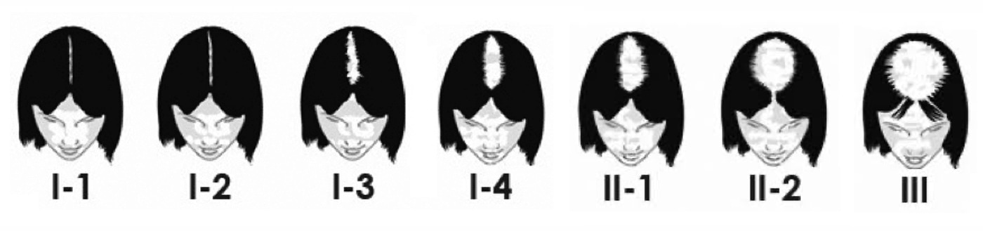 Les différents stades de la calvitie féminine selon la classification de Ludwig