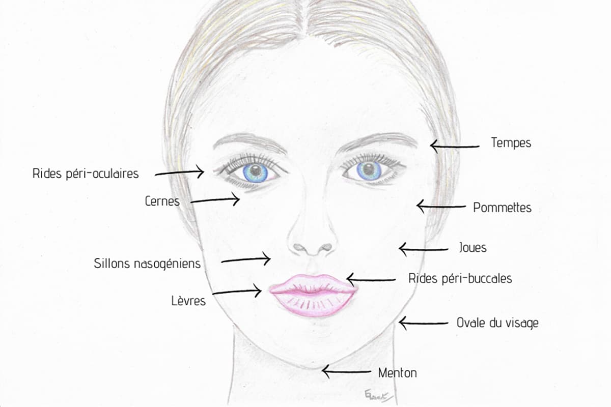 Zones d'injection d'acide hyaluronique sur le visage